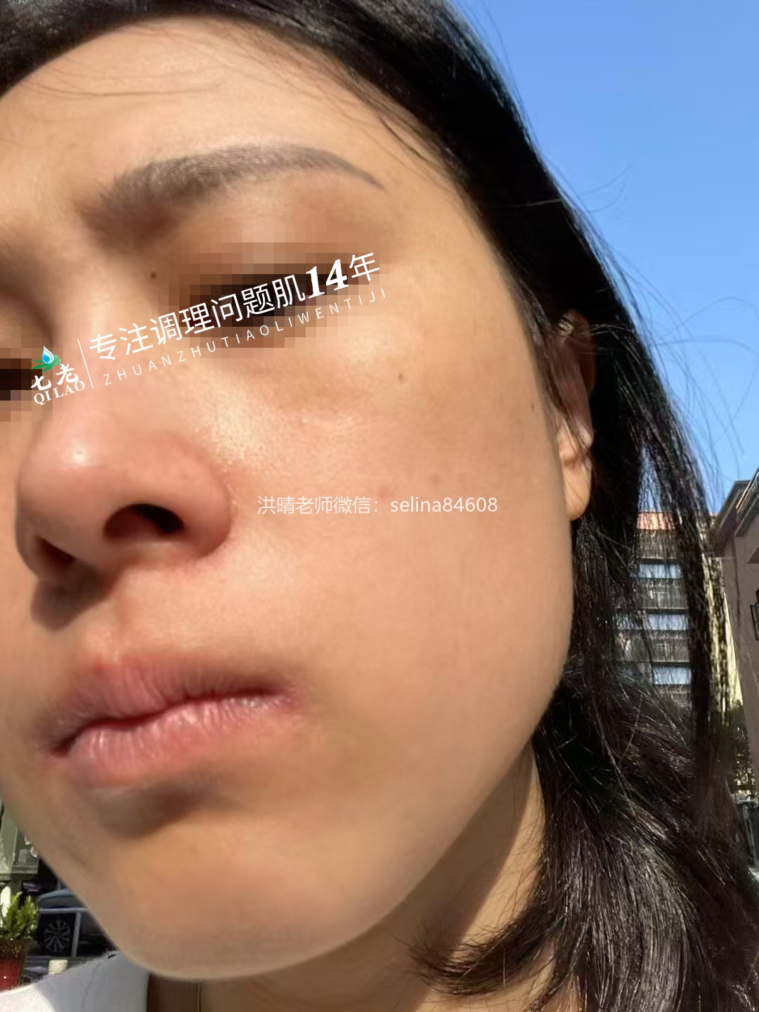 七老激素脸修护案例