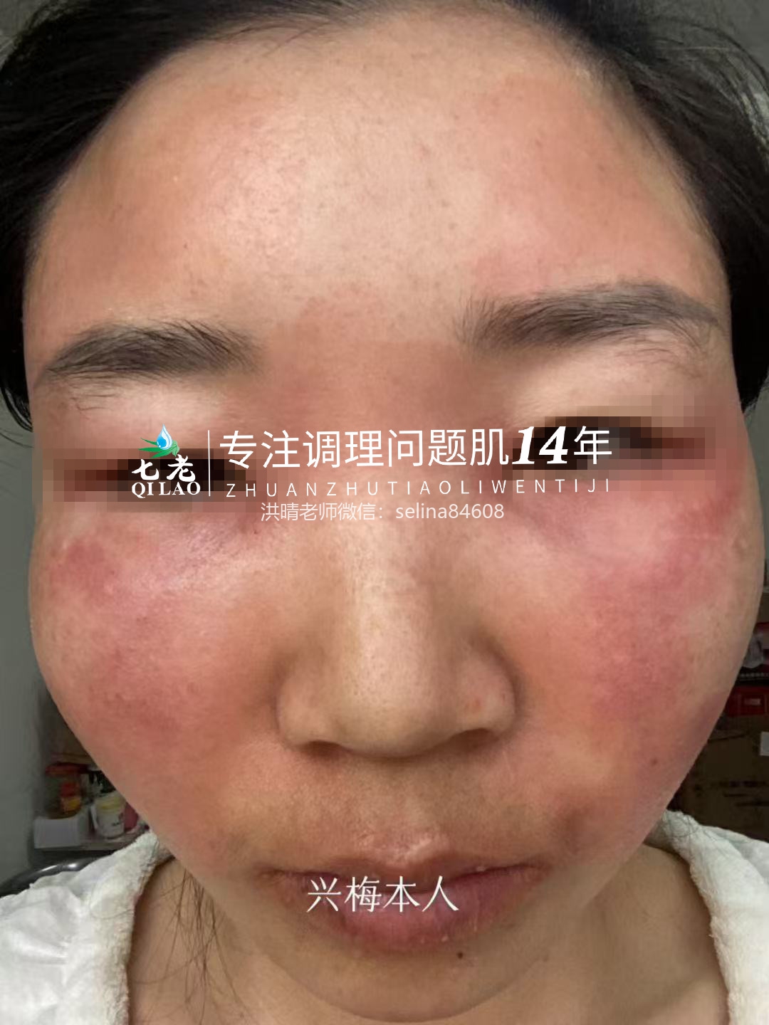 七老激素脸修护案例