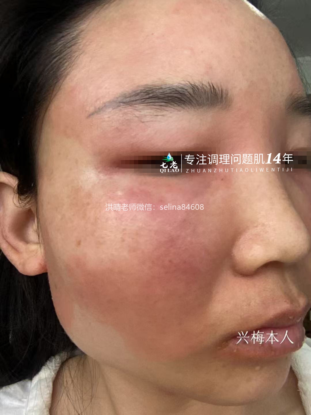 七老激素脸修护案例