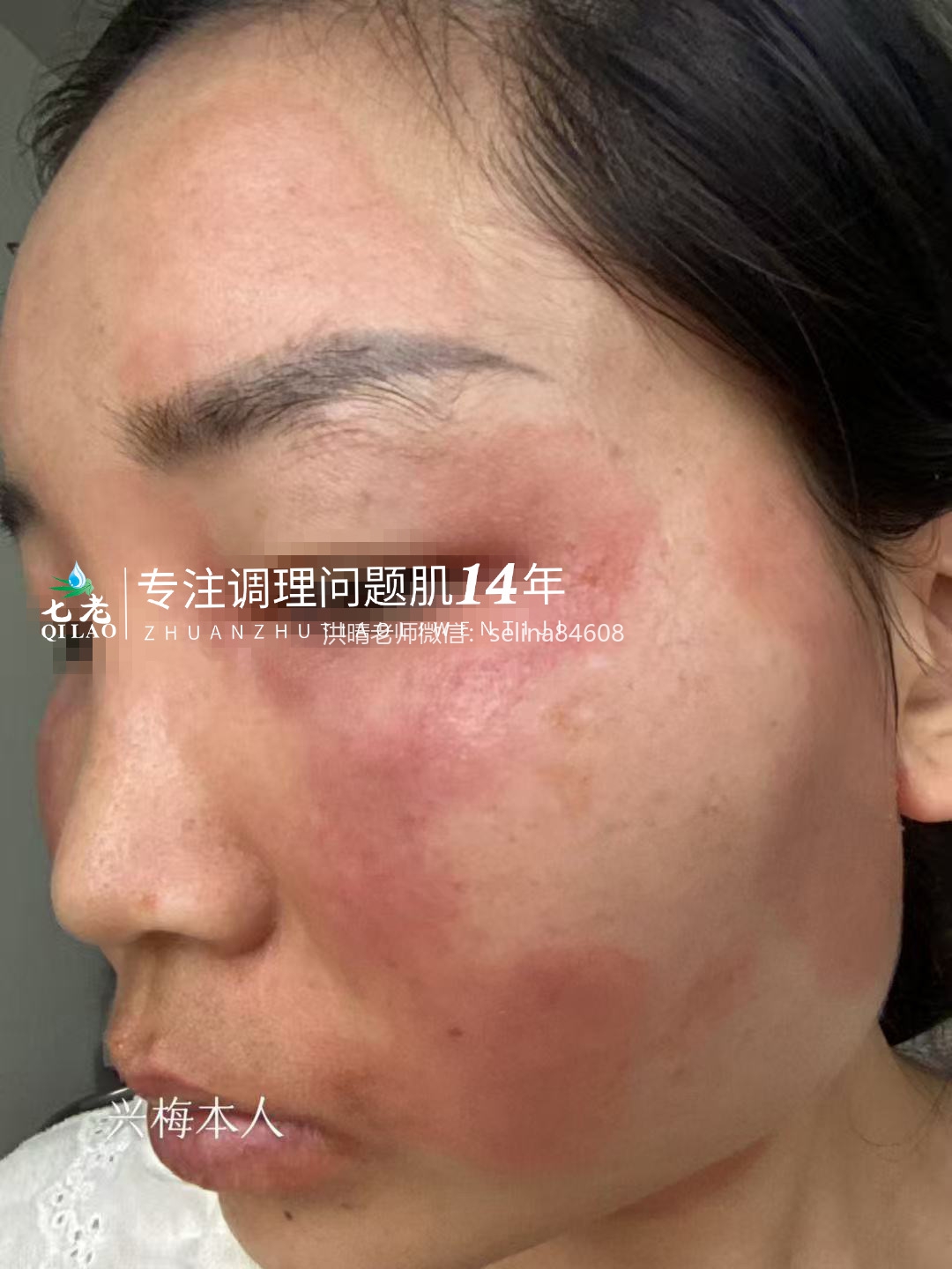 七老激素脸修护案例