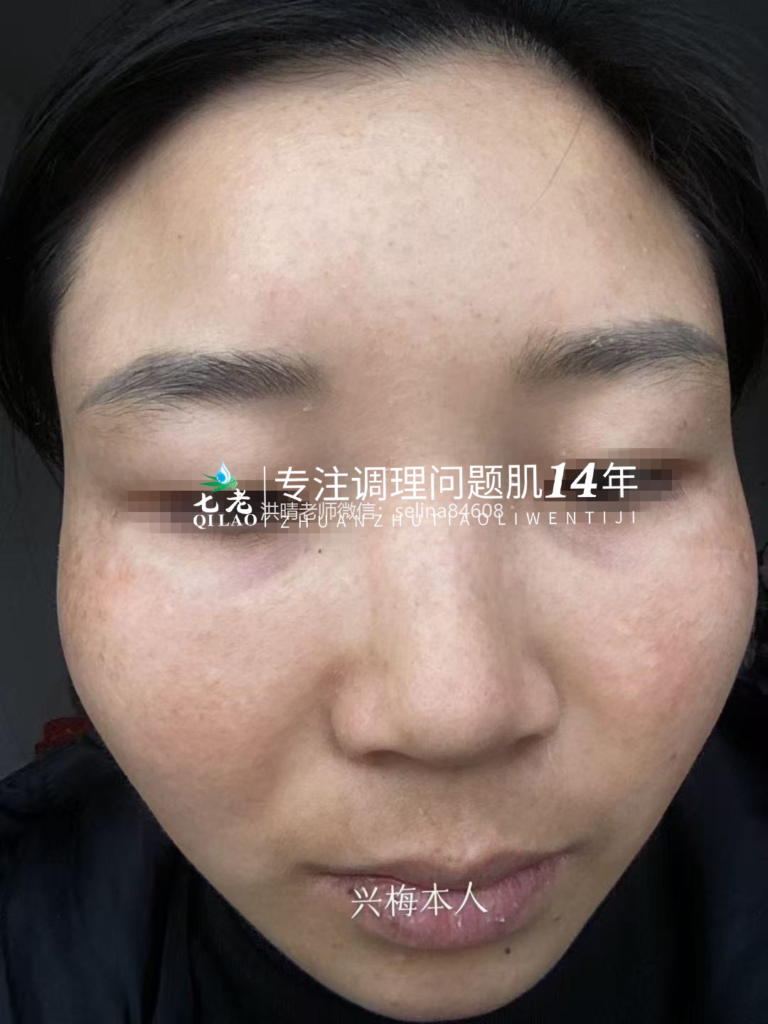 七老激素脸修护案例