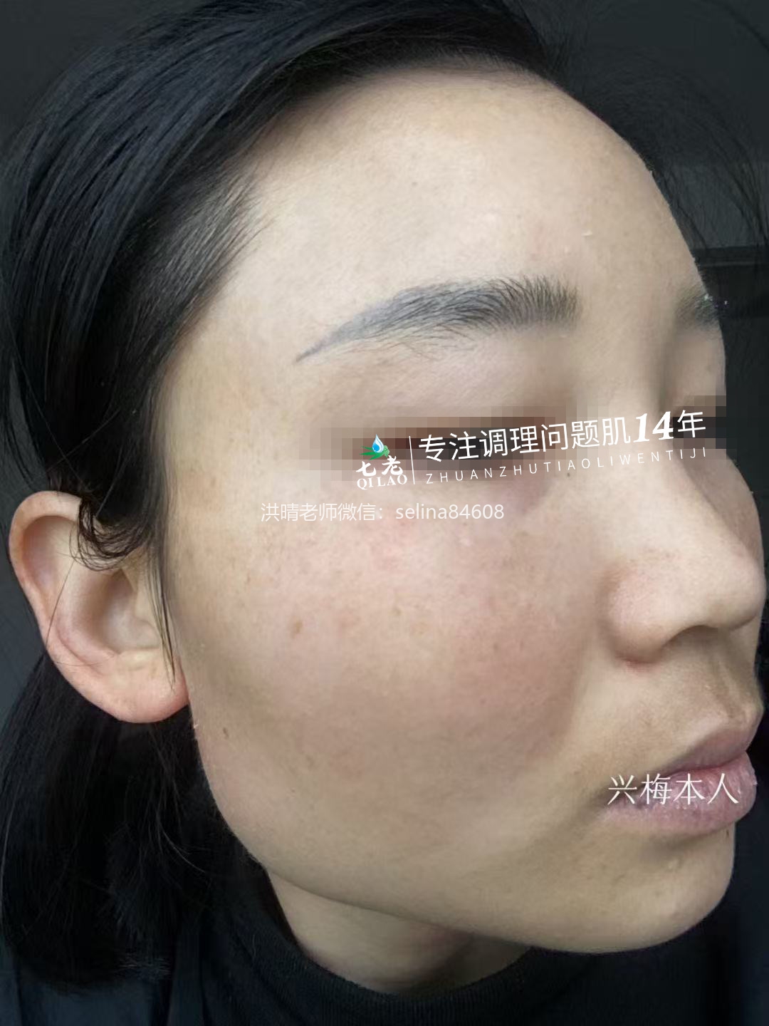 七老激素脸修护案例