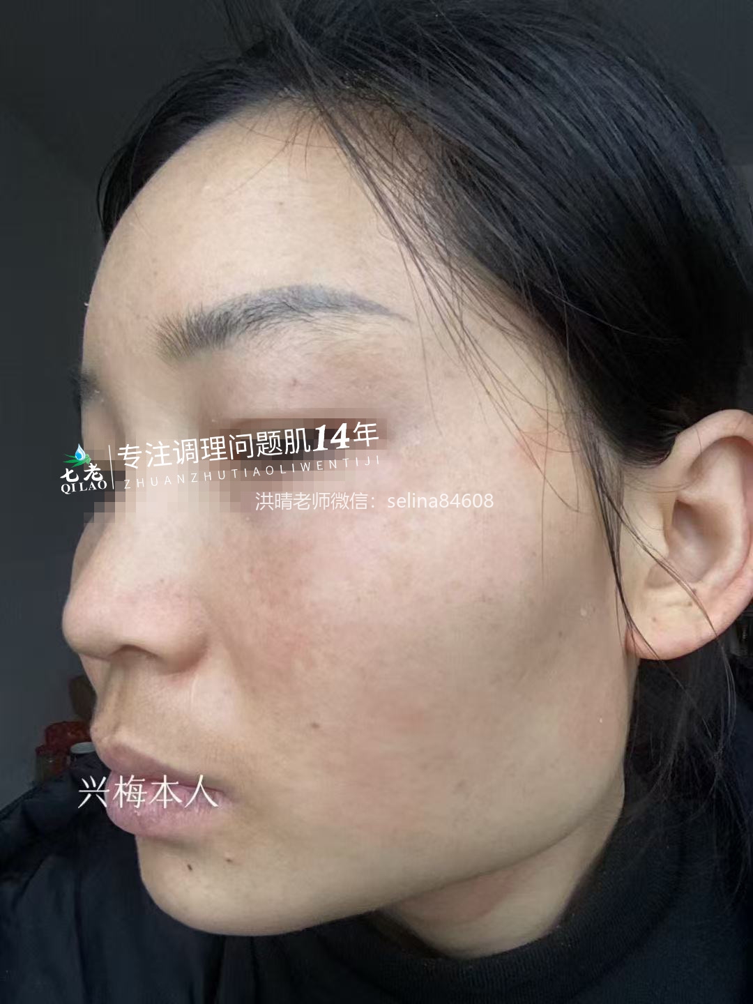 七老激素脸修护案例