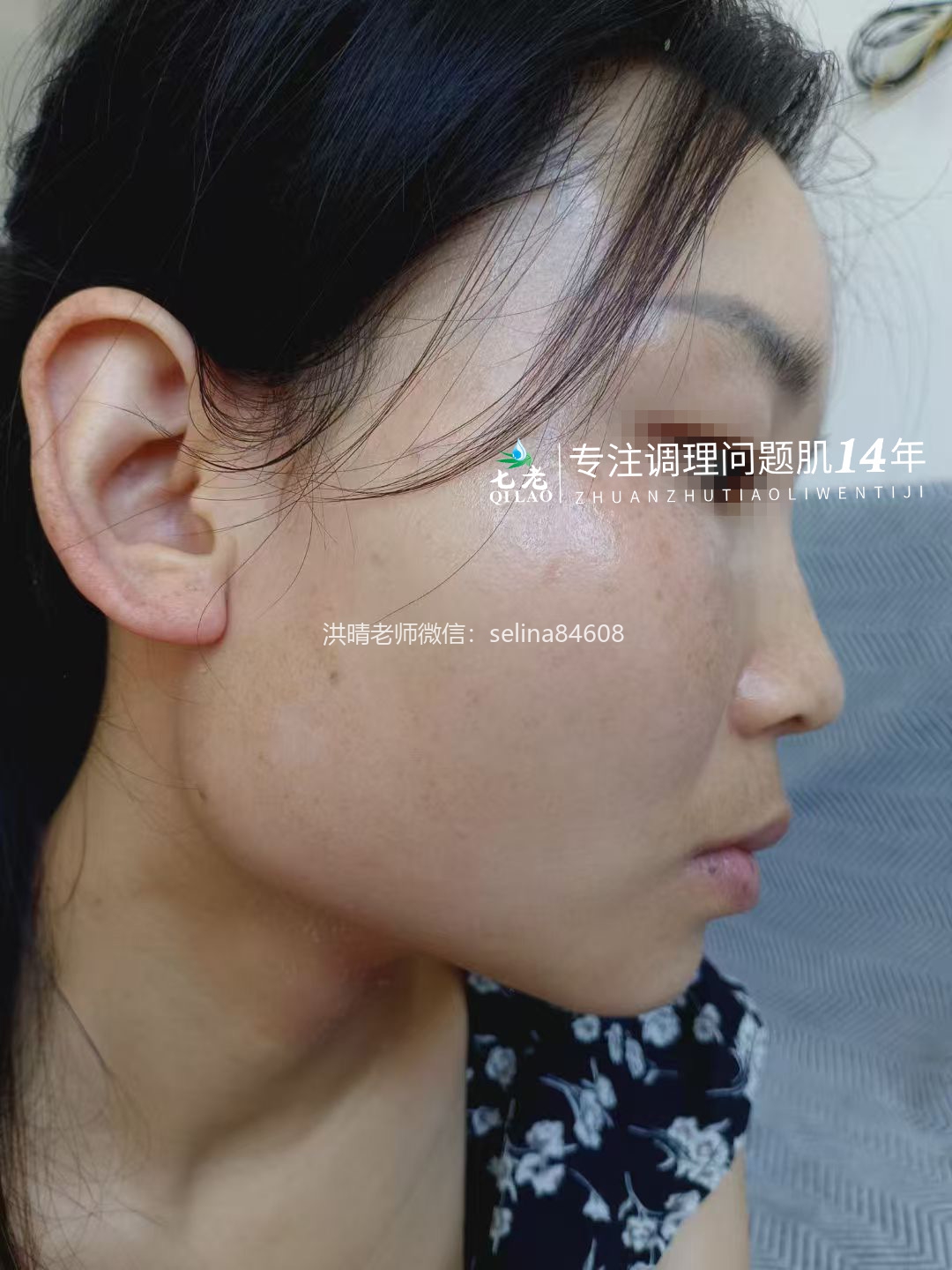 七老激素脸修护案例