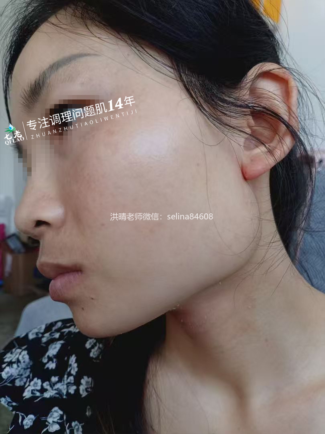 七老激素脸修护案例