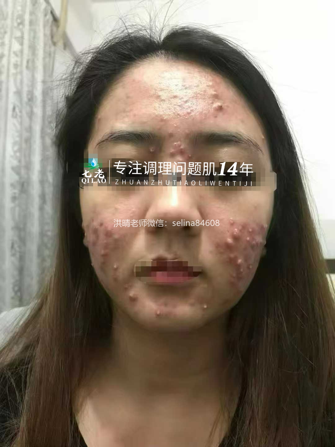 七老激素脸顽固性脓包痘痘修护案例