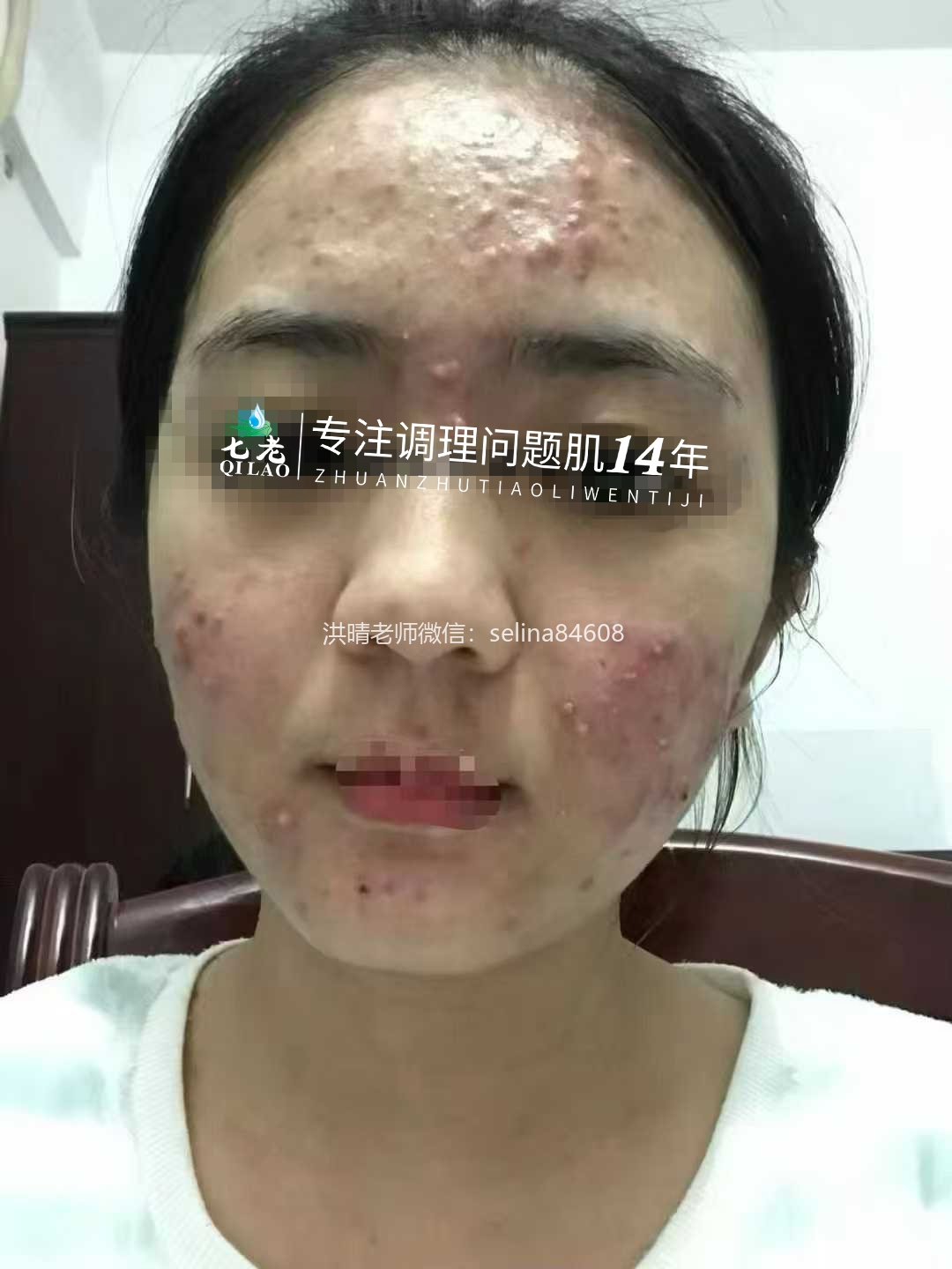 七老激素脸顽固性脓包痘痘修护案例