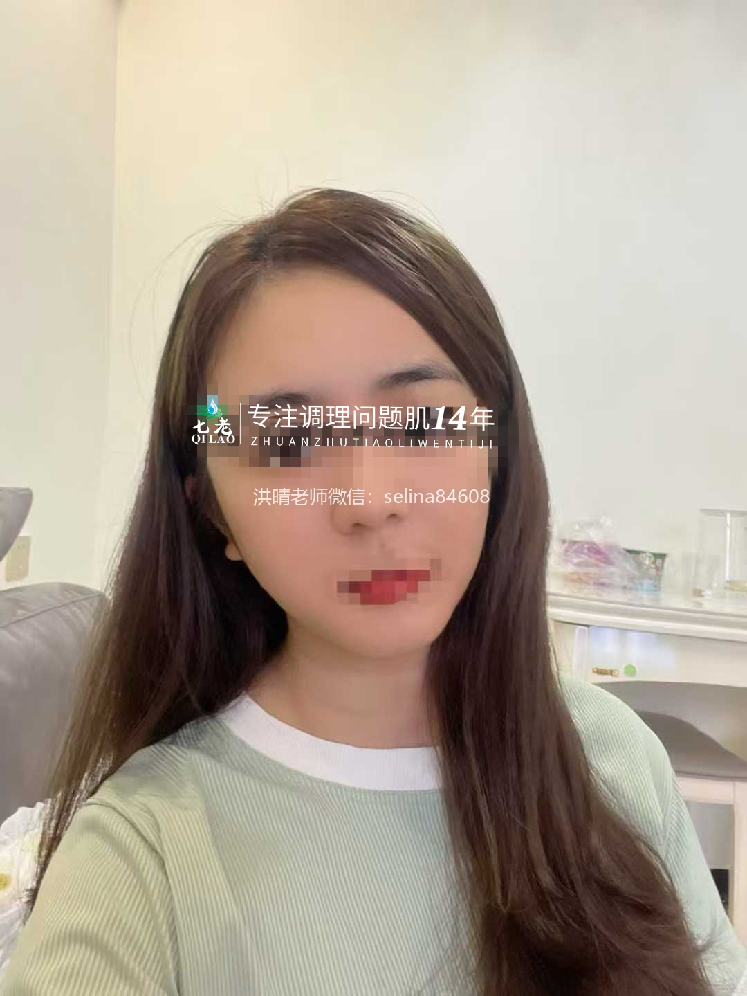 七老激素脸顽固性脓包痘痘修护案例