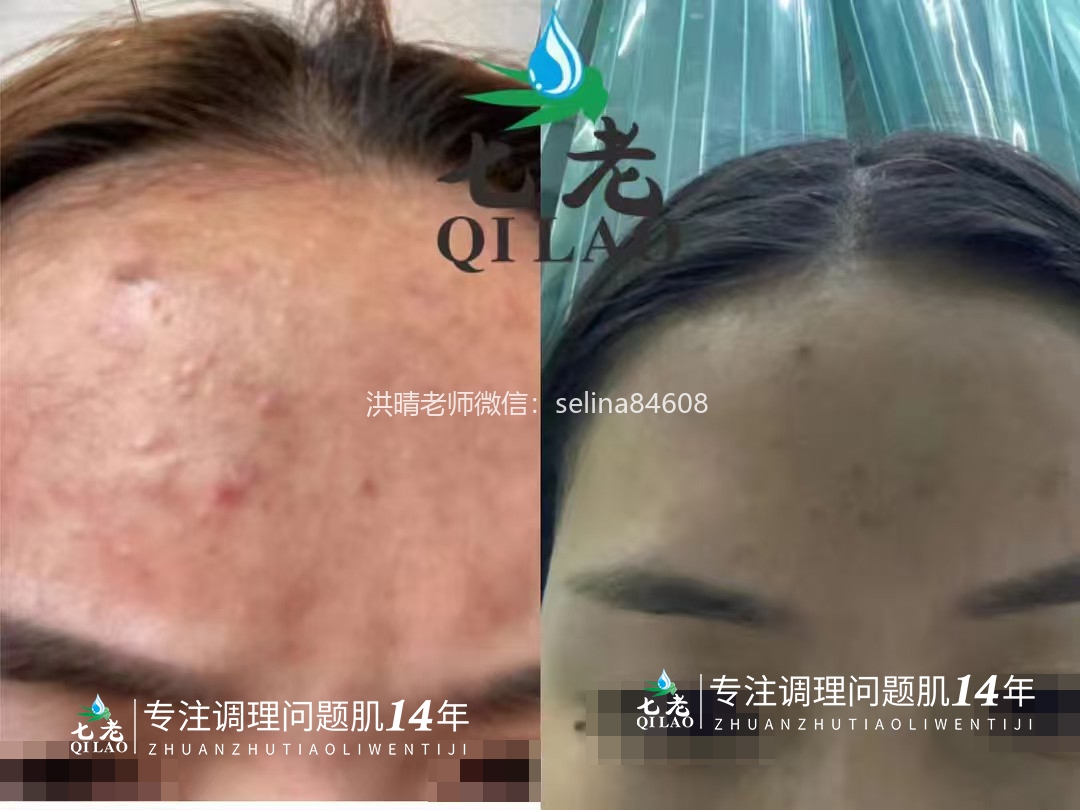 激素脸激素痘顽固性粉刺痘痘修护案例