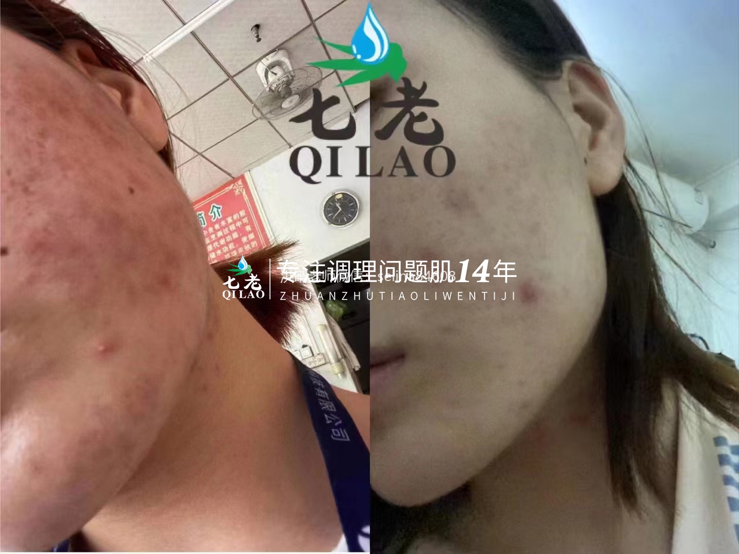 激素脸激素痘顽固性粉刺痘痘修护案例