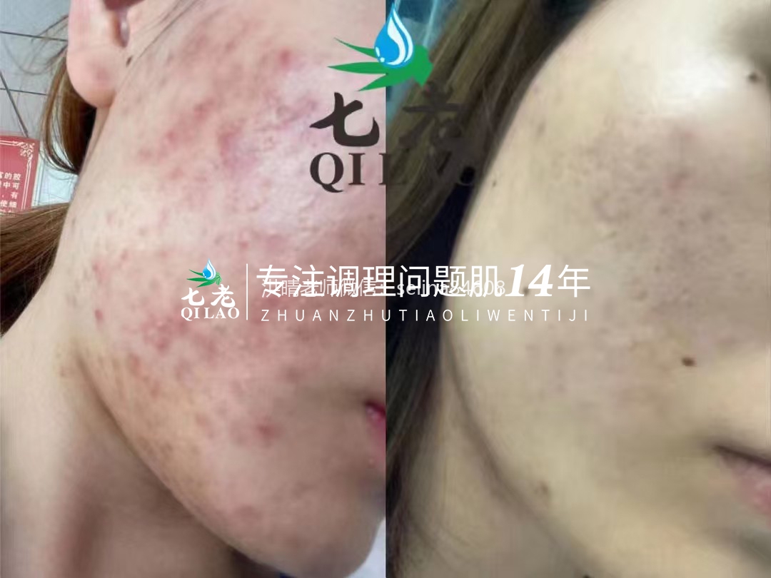 激素脸激素痘顽固性粉刺痘痘修护案例