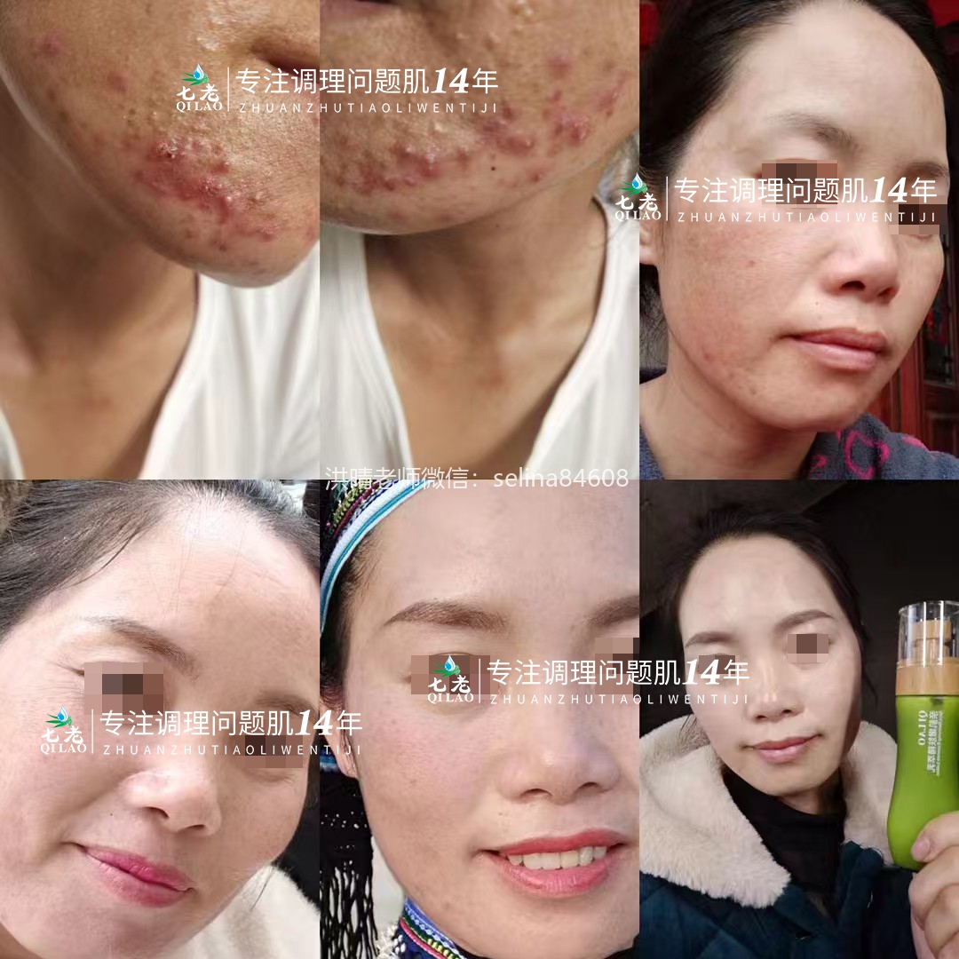 七老严重激素脸脓包痘痤疮修护案例