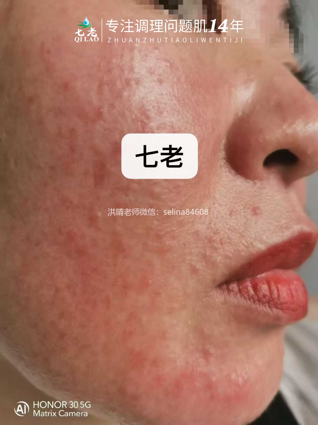 七老激素脸修护案例