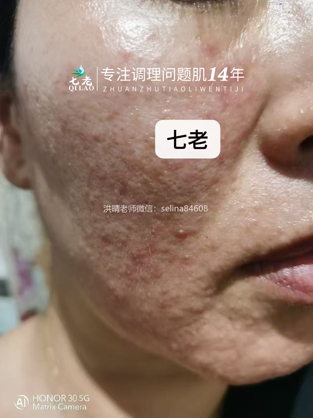 七老激素脸修护案例