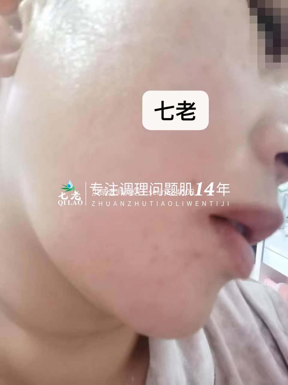 七老激素脸修护案例