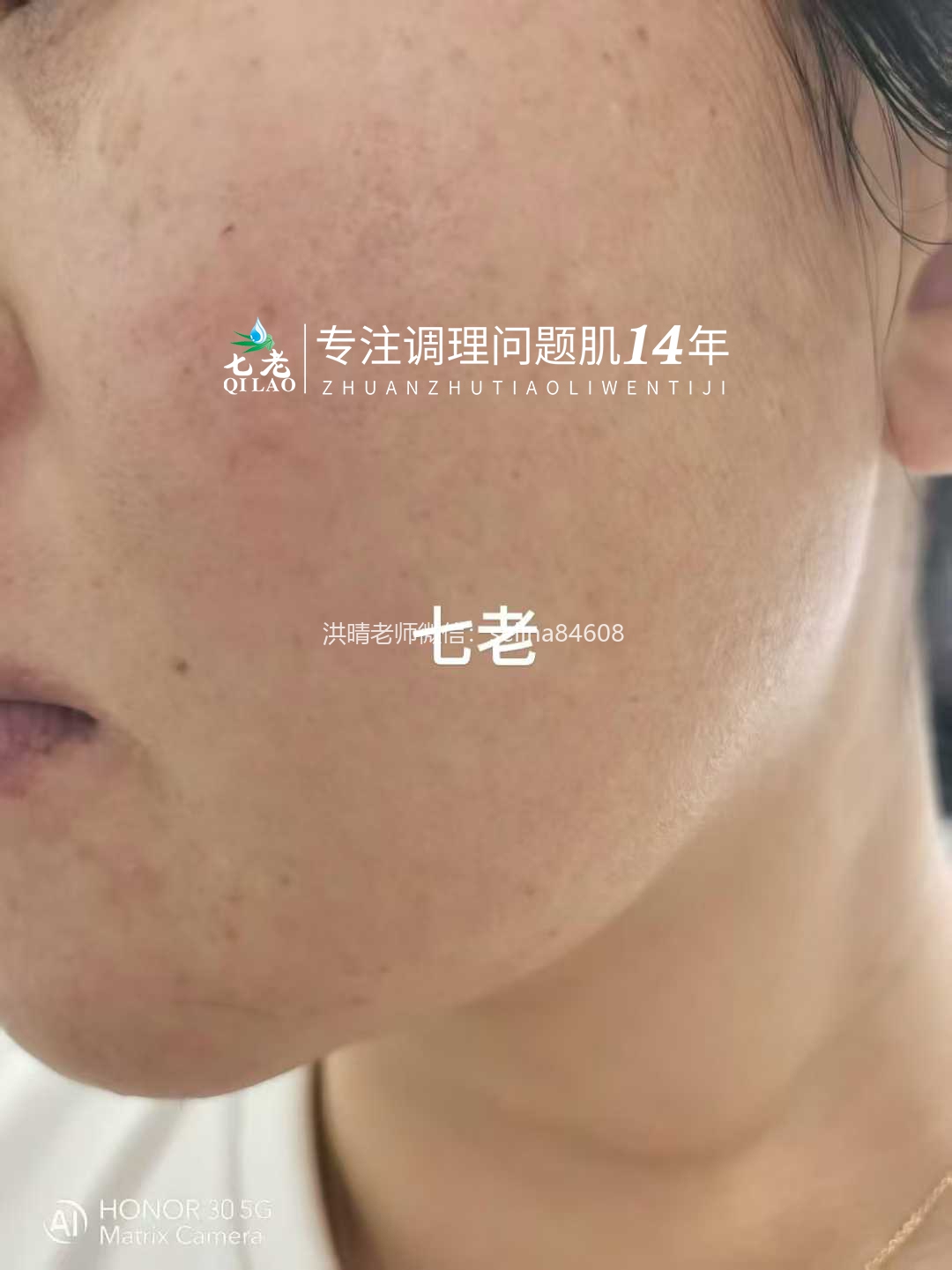 七老激素脸修护案例