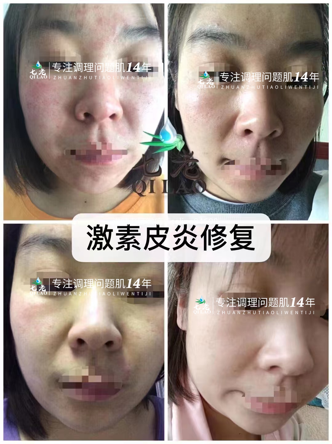 七老激素脸修复案例