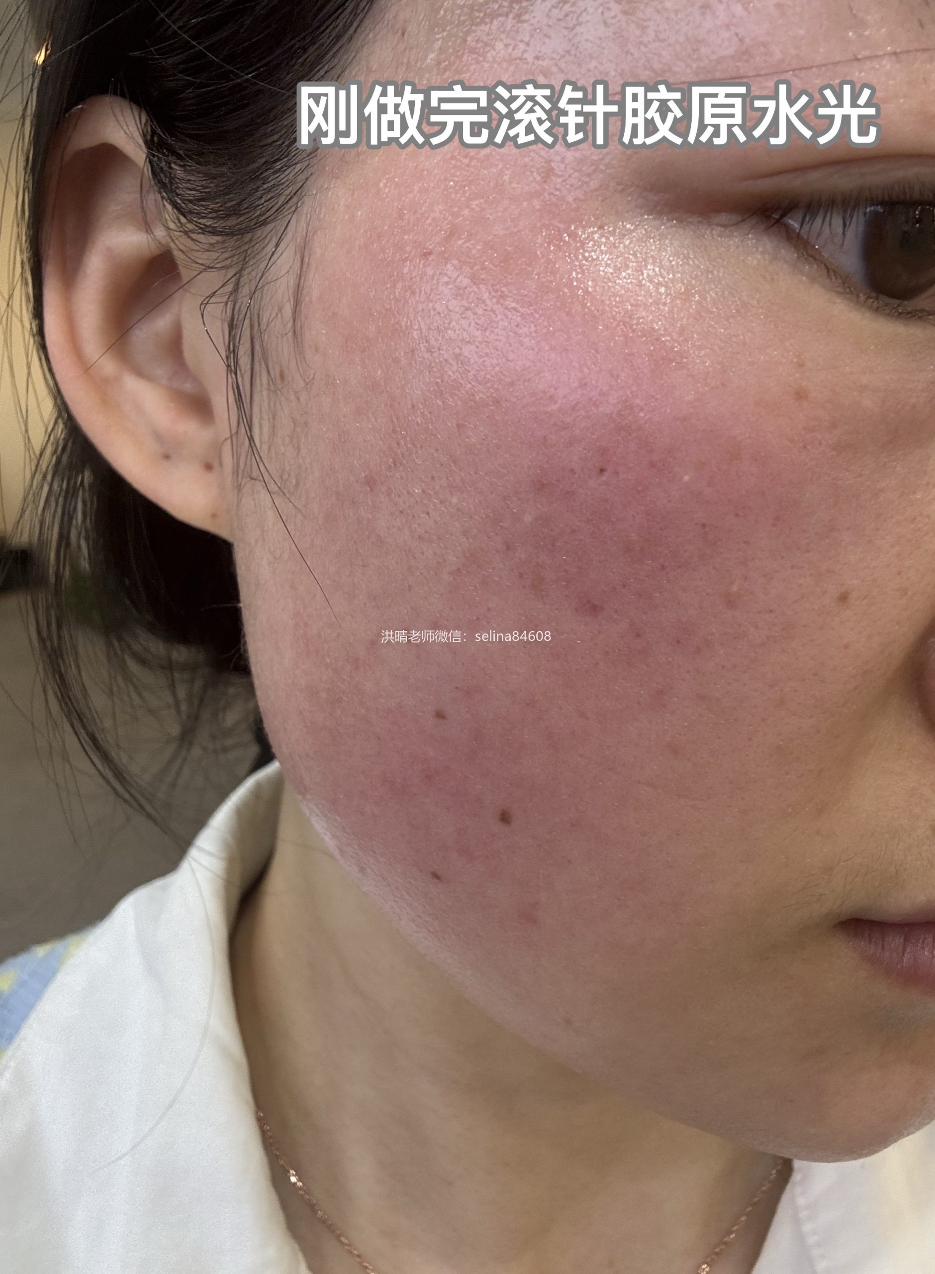 七老新品胶原水光签约官方授权