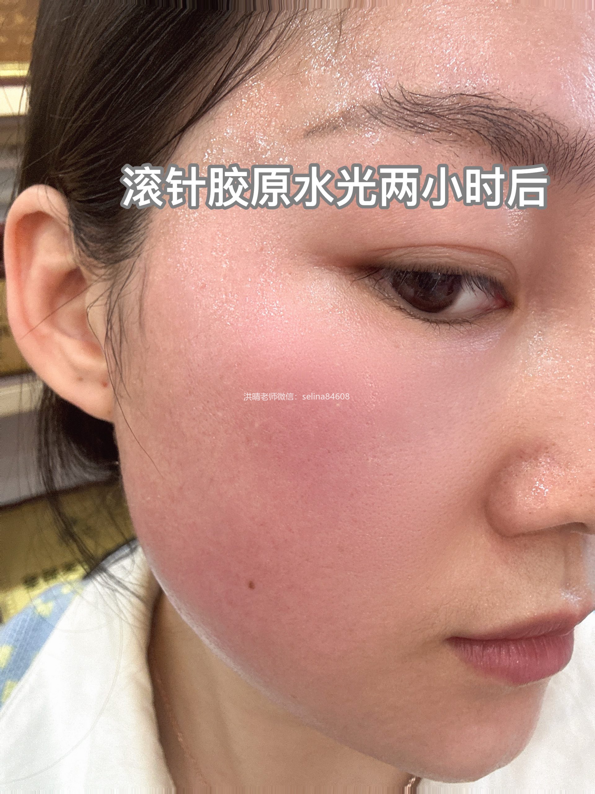 七老新品胶原水光签约官方授权