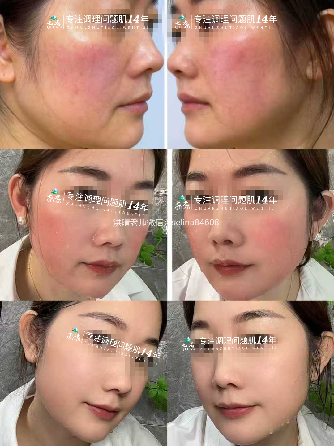 七老激素脸红烫大红脸修护案例