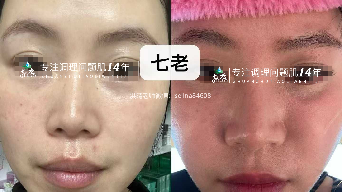 七老发红发烫大红脸红烫肌修护案例