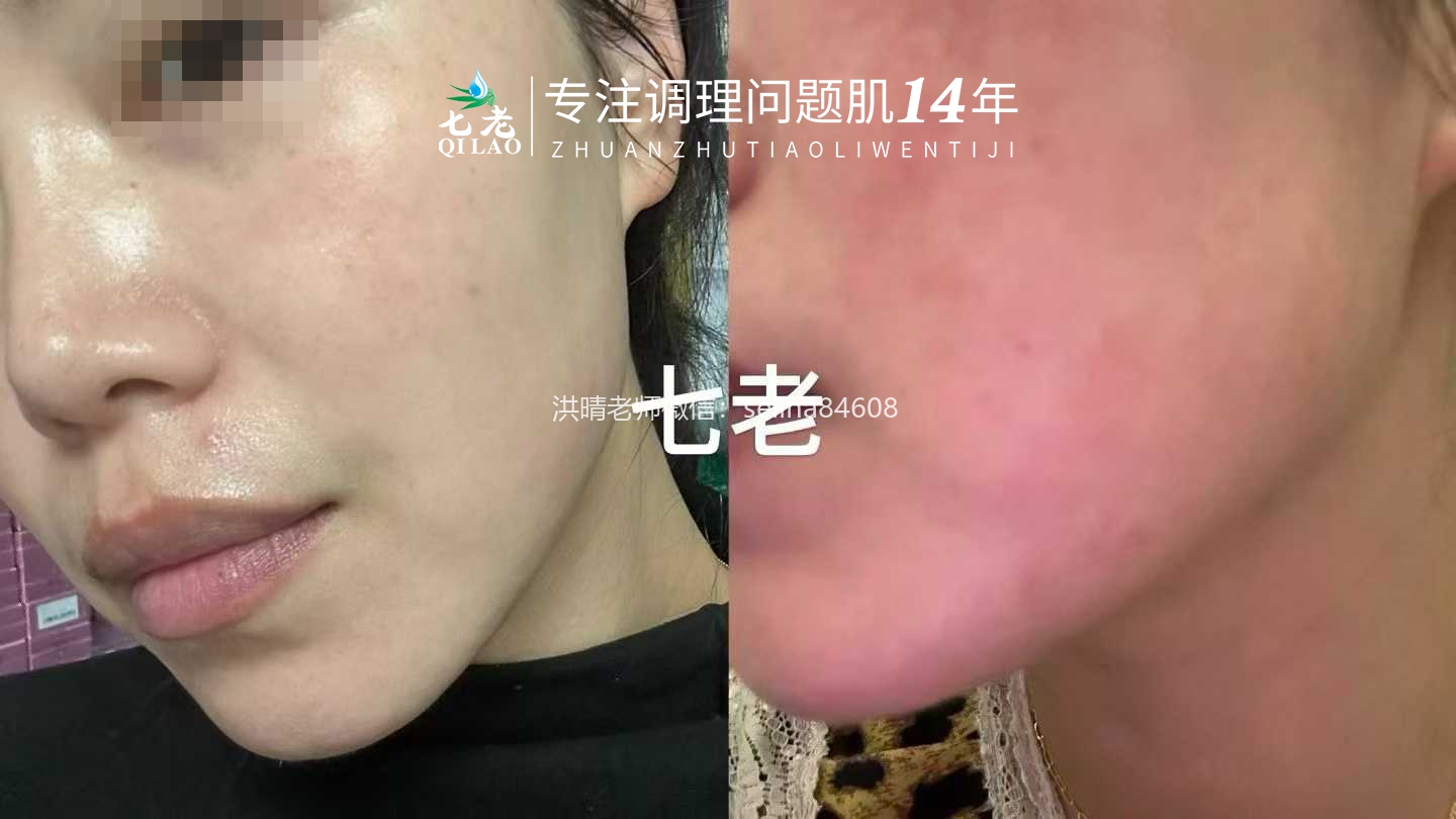 七老发红发烫大红脸红烫肌修护案例