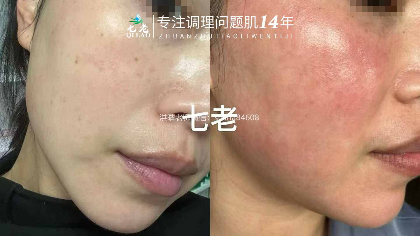 七老发红发烫大红脸红烫肌修护案例