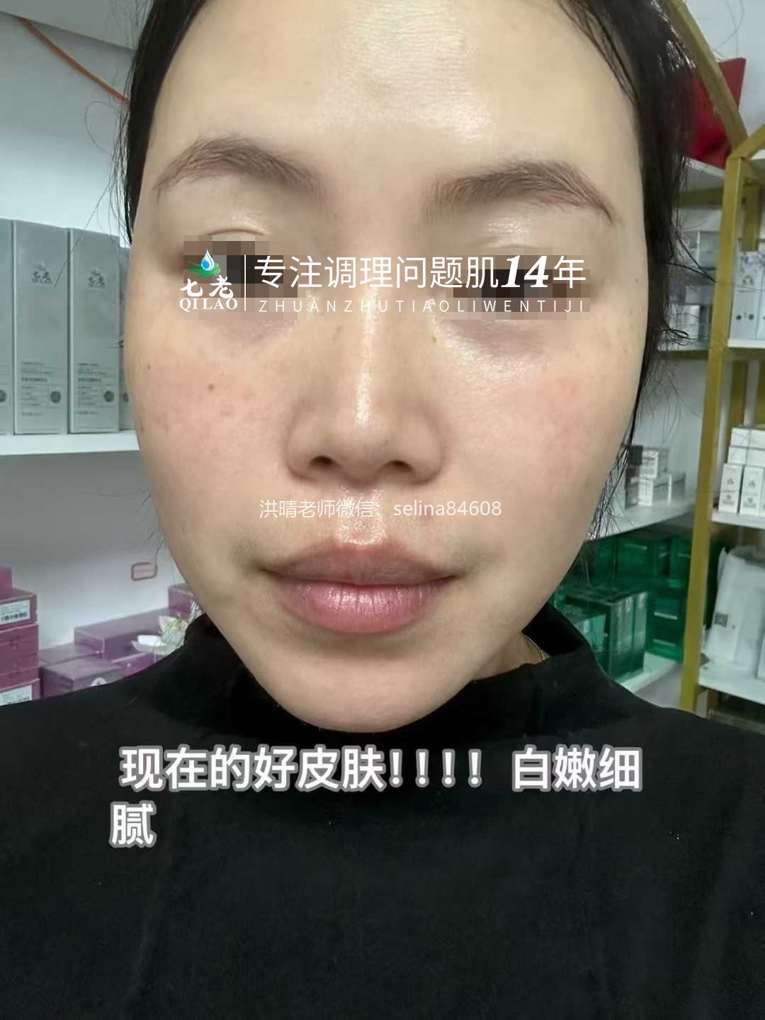 七老发红发烫大红脸红烫肌修护案例