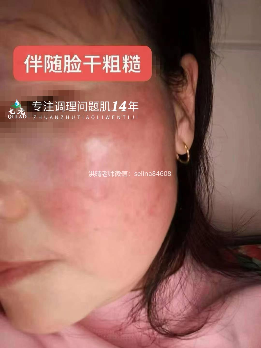 七老红烫肌发红发烫大红脸修护记录