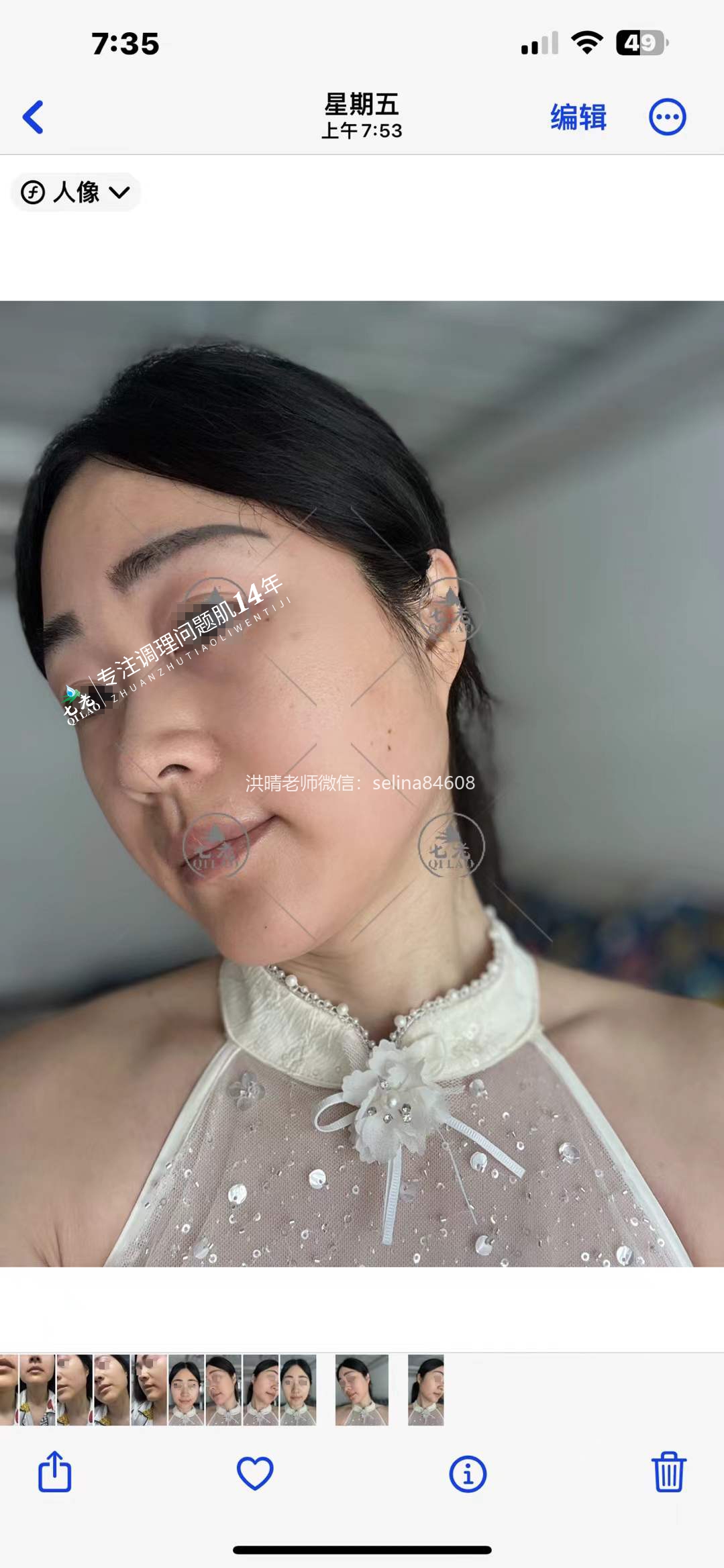 七老反复过敏修护案例