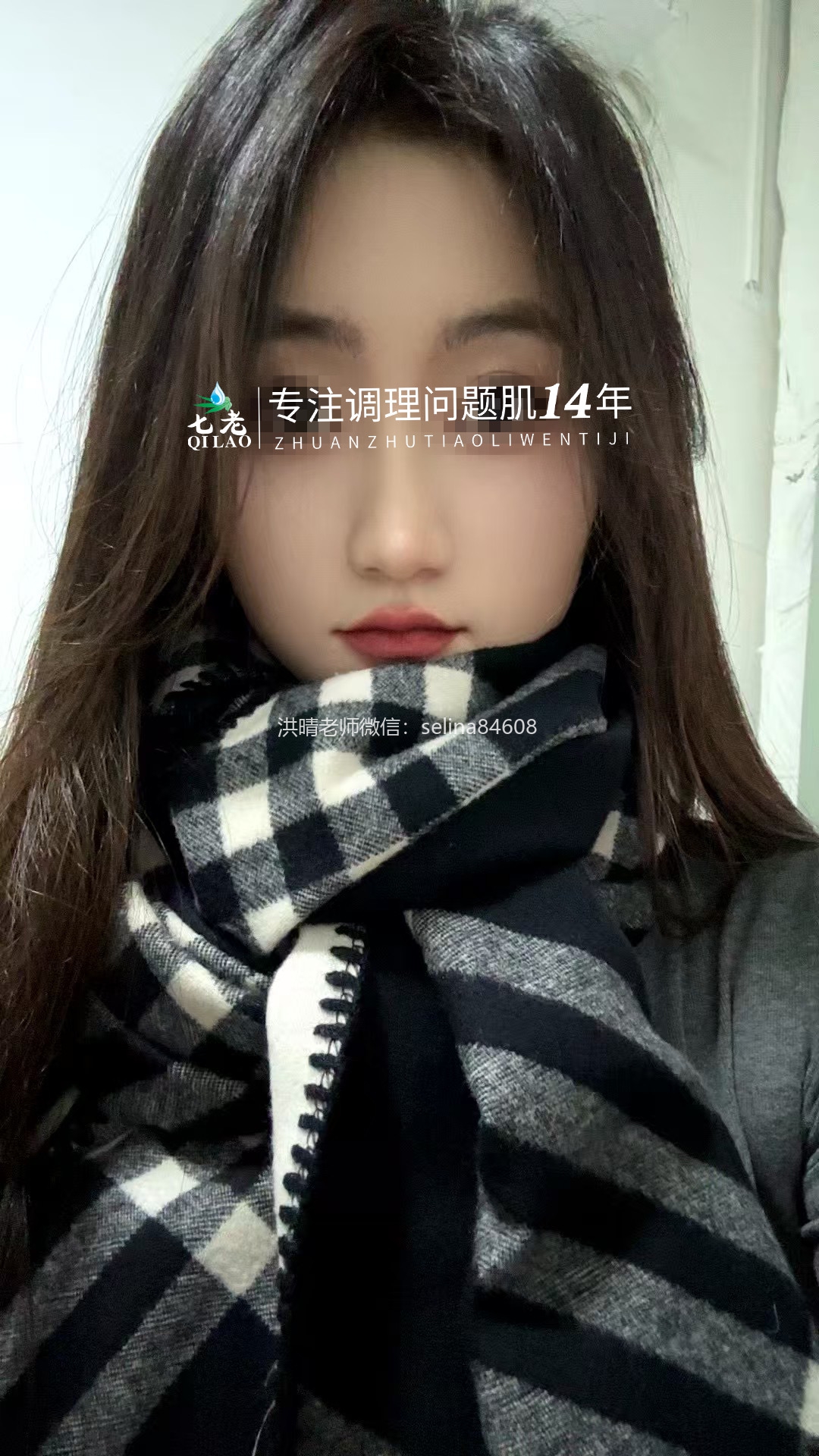 七老激素脸玫瑰皮修复案例