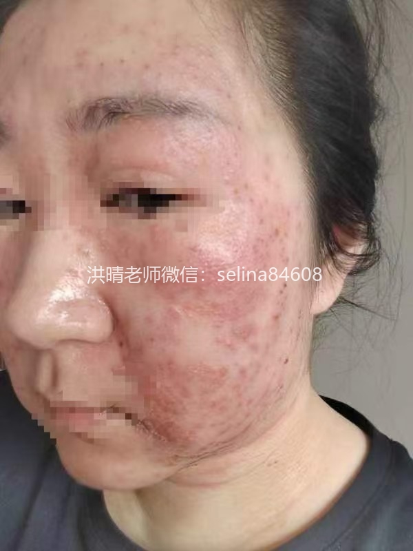 七老严重激素脸修复案例