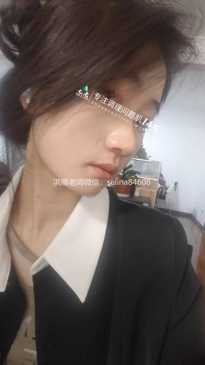 七老激素脸玫瑰皮修复案例