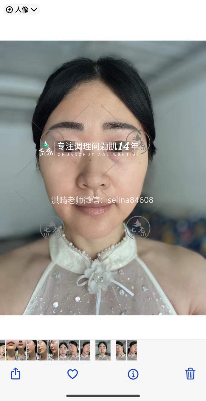 七老反复过敏修护案例