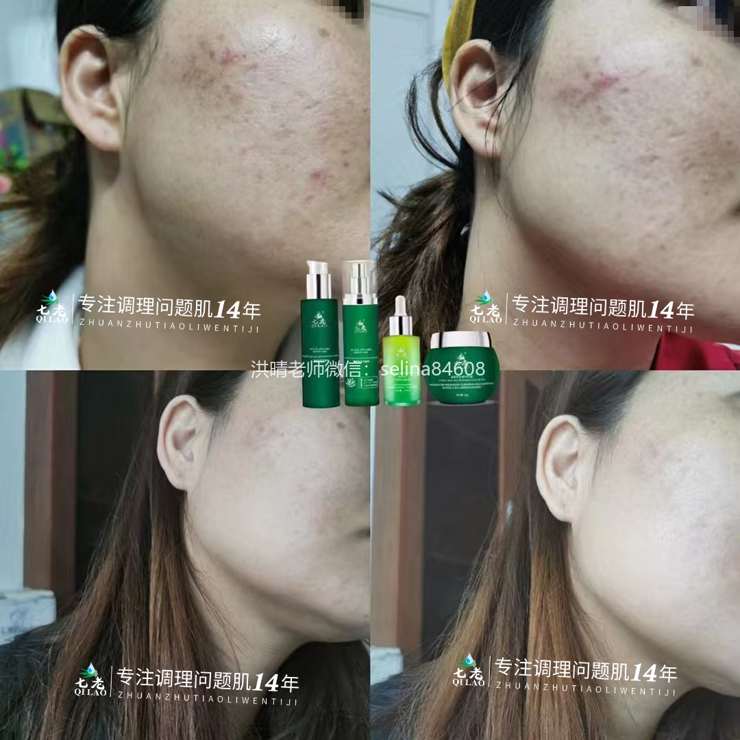 七老痘痘肌修护案例脸上长痘怎么办
