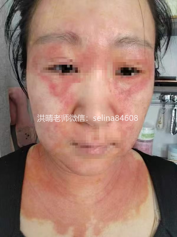 七老严重激素脸修复案例