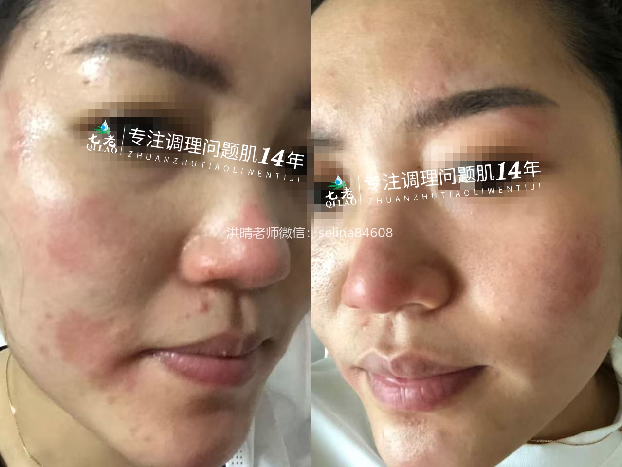 七老激素脸修护案例