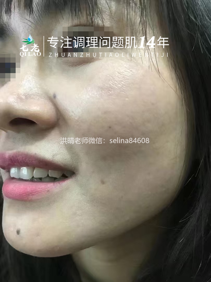 七老反复过敏修复案例