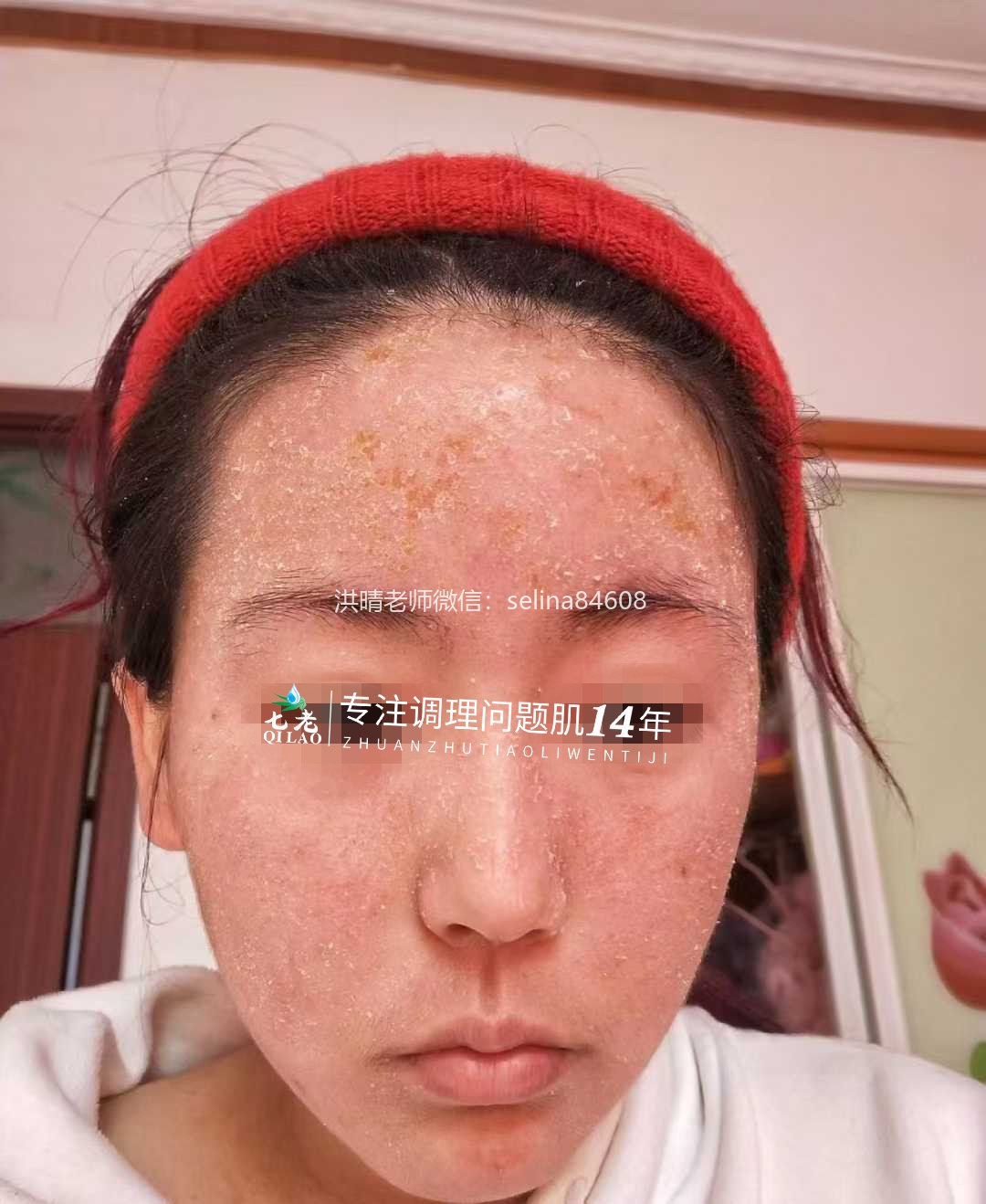 七老激素脸玫瑰脸修护案例