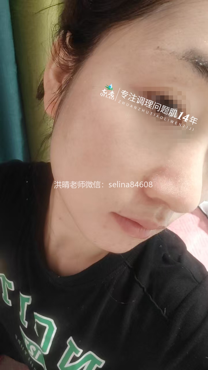 七老激素脸玫瑰皮修复案例