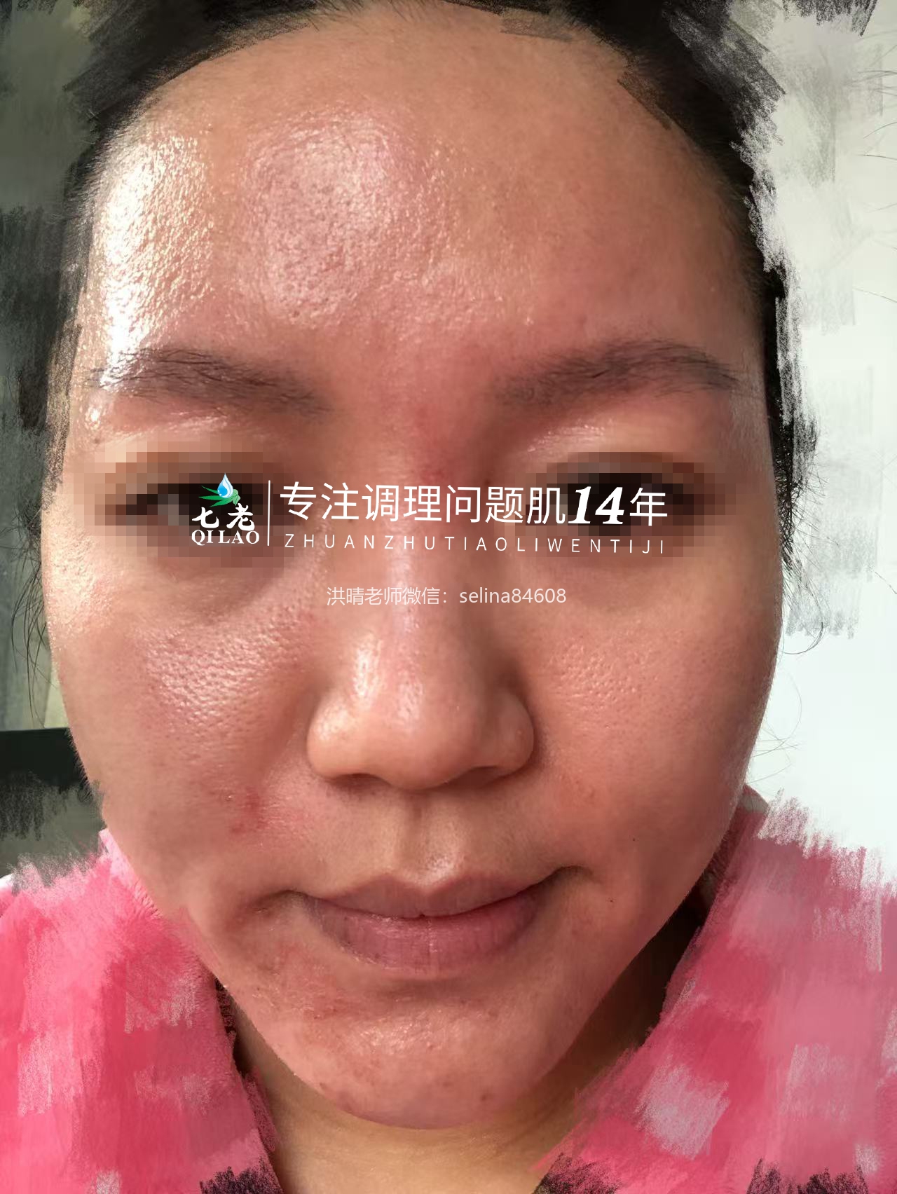 七老激素脸修护案例