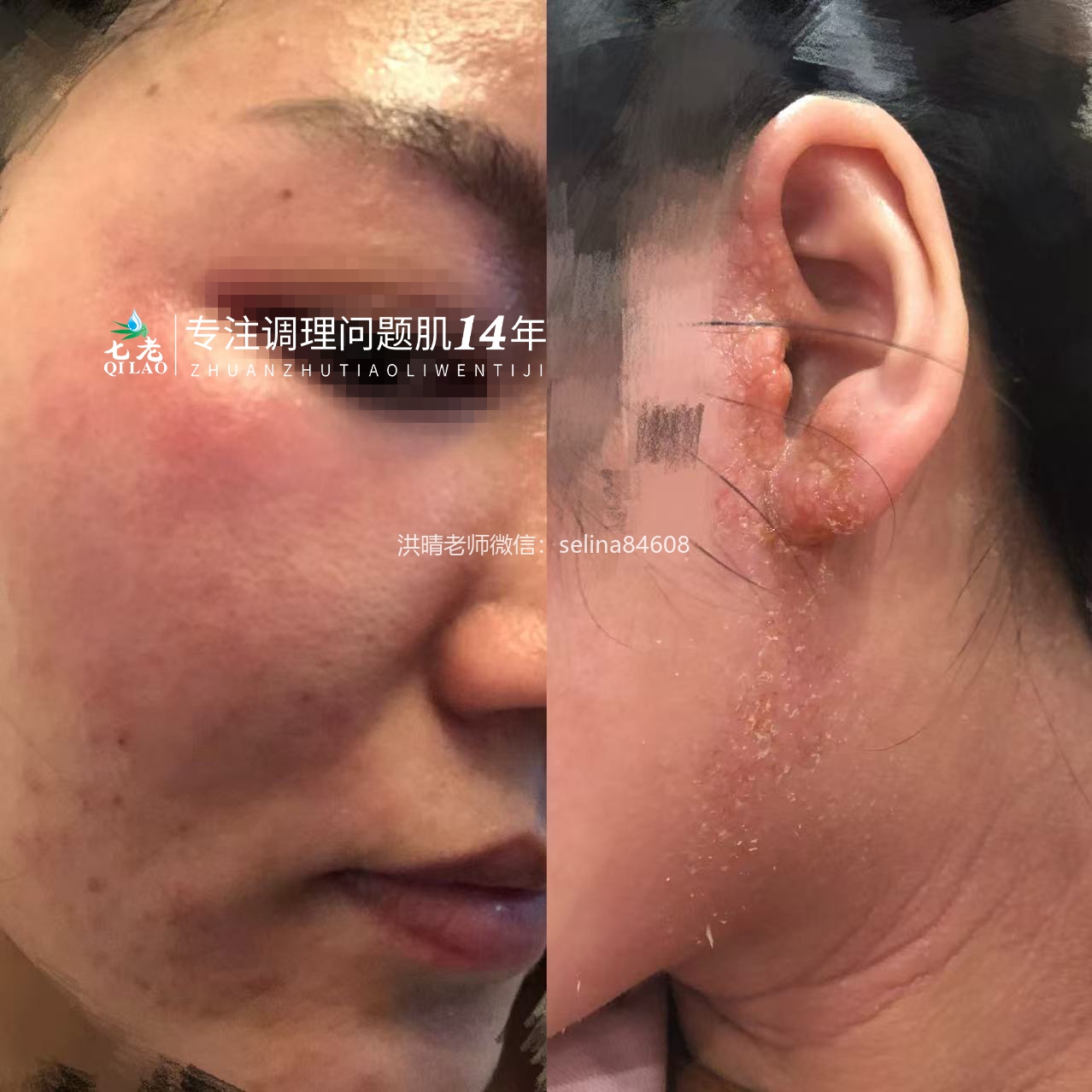 七老激素脸修护案例