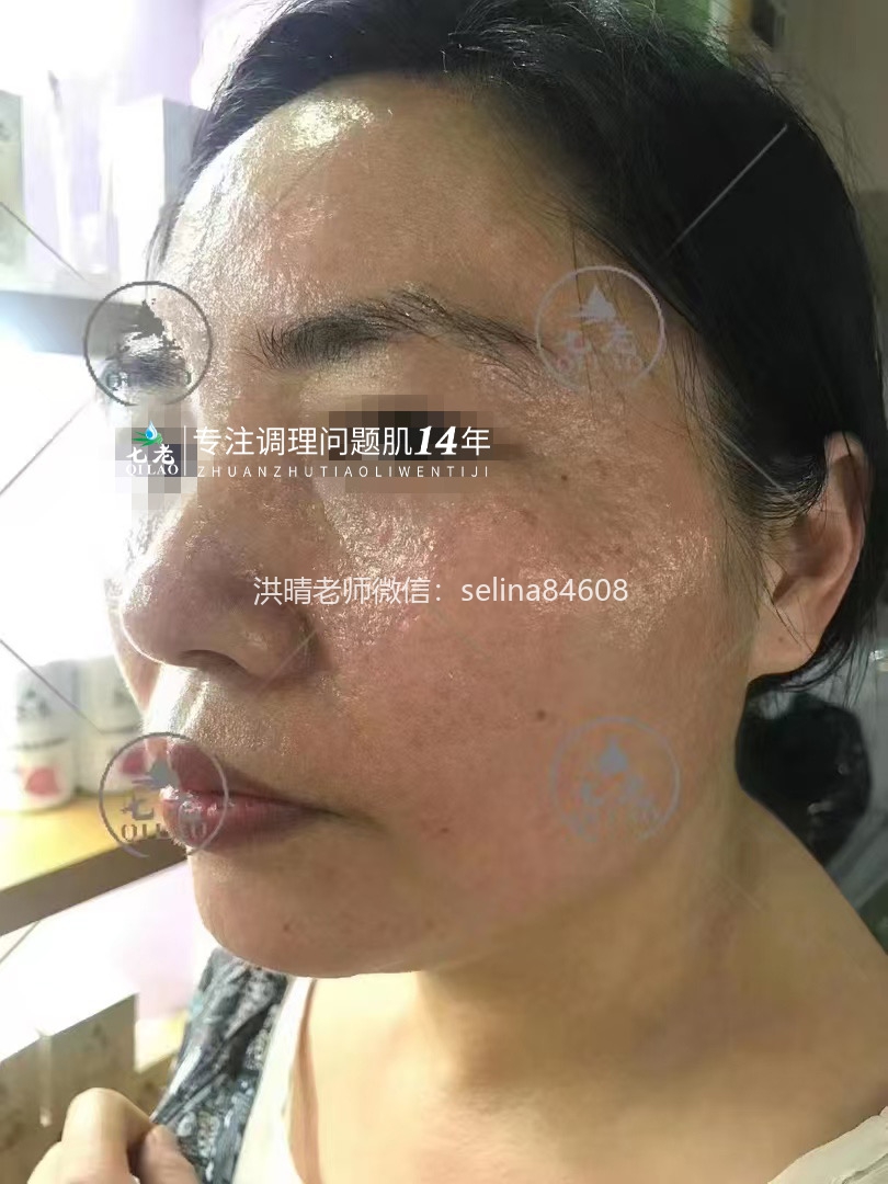 七老日光性皮炎修护案例