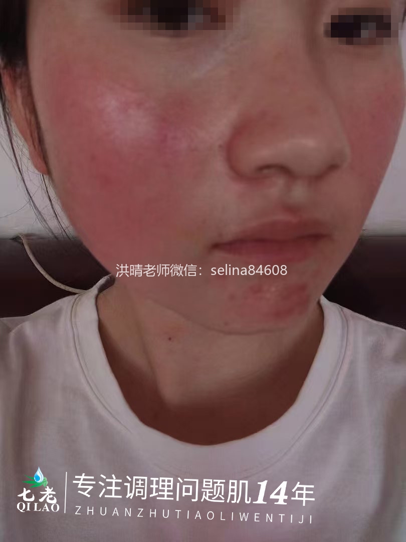 七老激素脸玫瑰皮修复案例