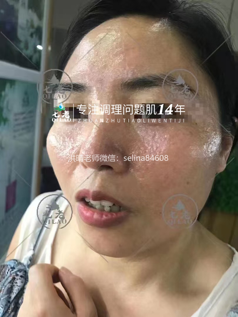 七老日光性皮炎修护案例