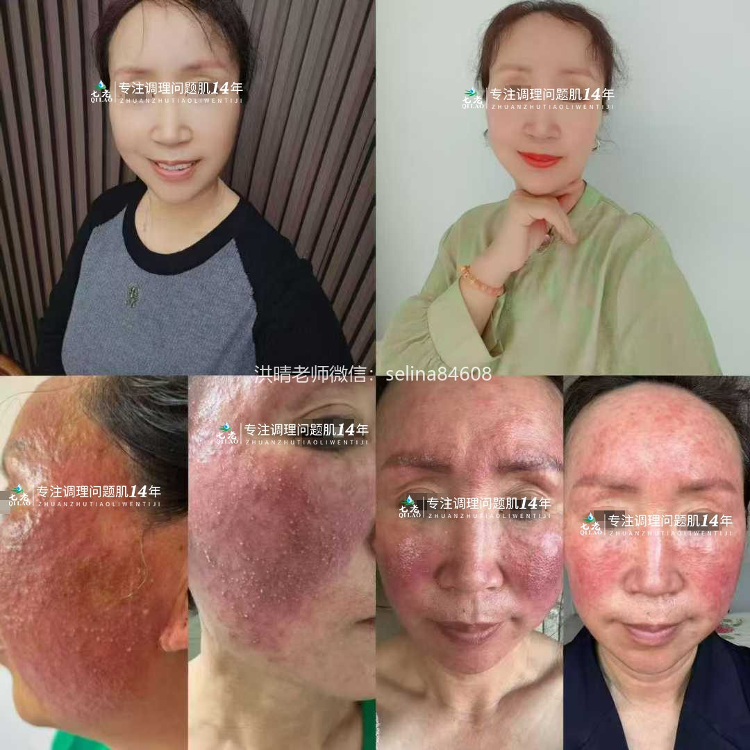 七老严重激素脸案例，从受益者变成守护者