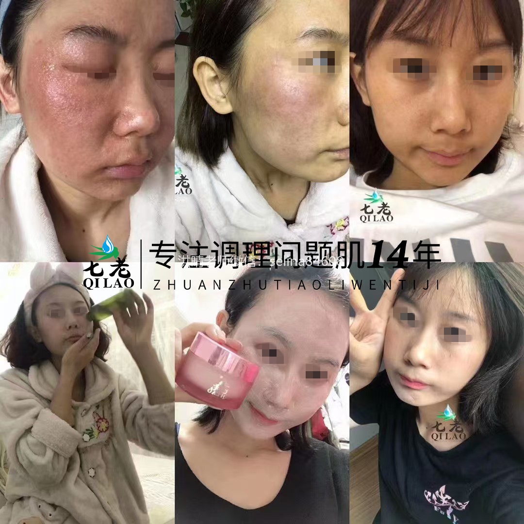 七老激素脸修护案例