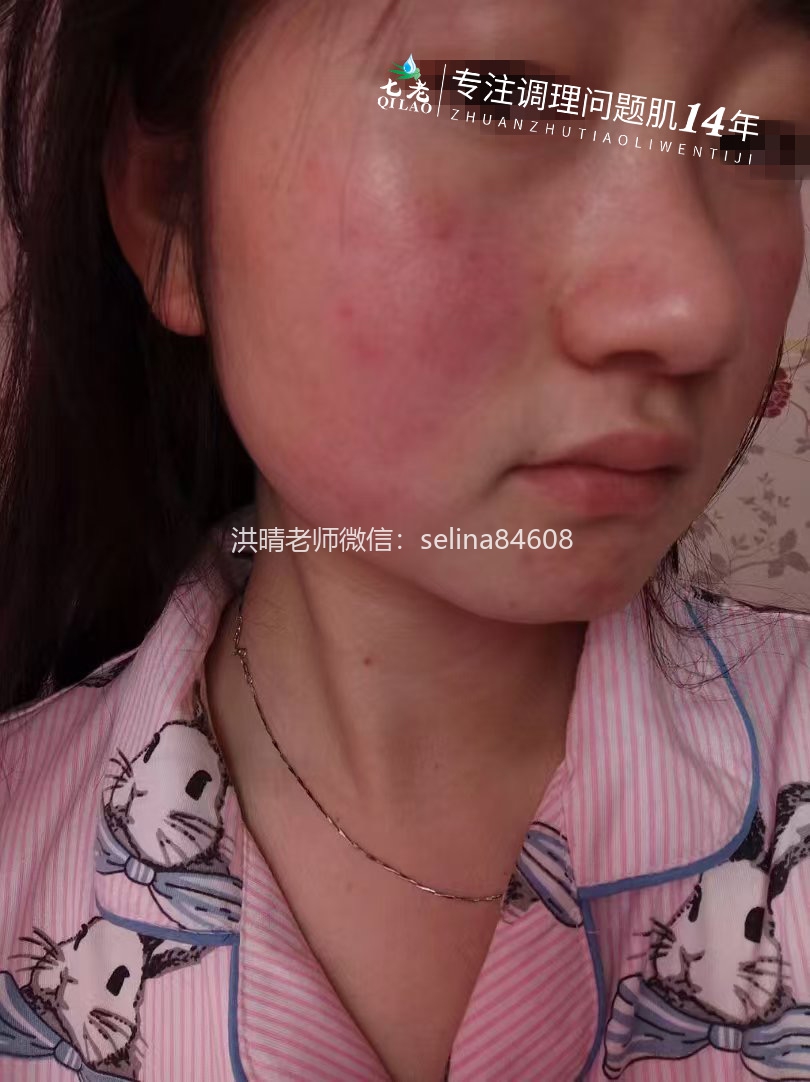 七老激素脸玫瑰皮修复案例