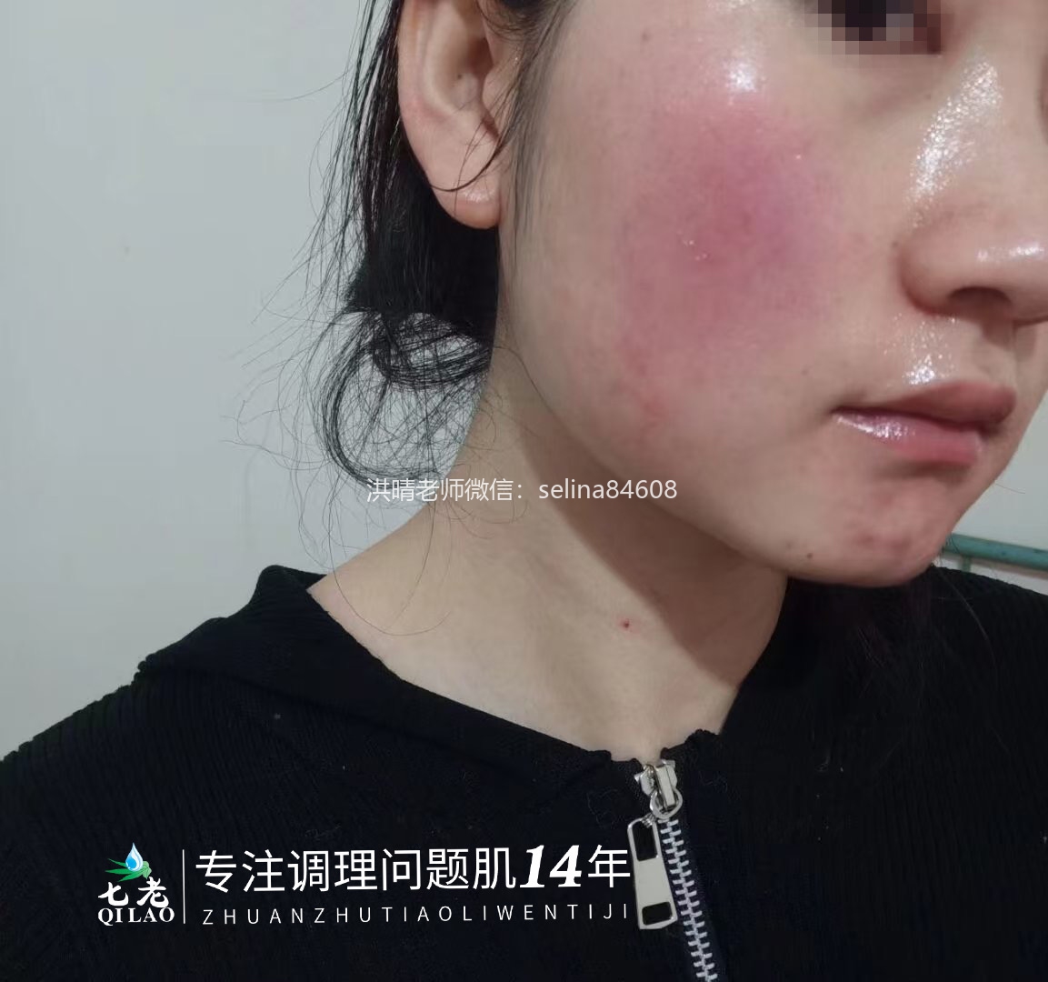 七老激素脸玫瑰皮修复案例