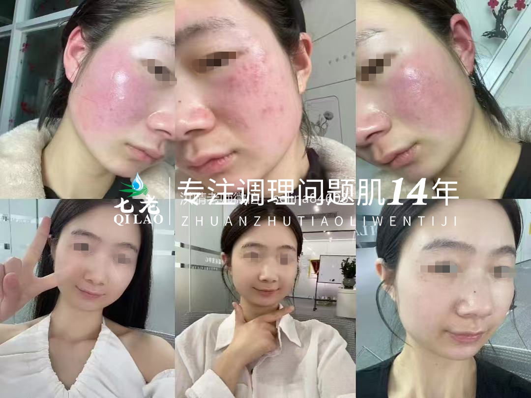 七老激素脸修复案例